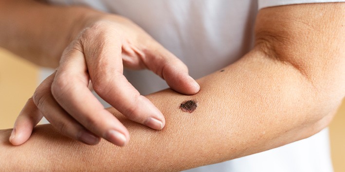 Cancer de pele melanoma ferida que nao cicatriza